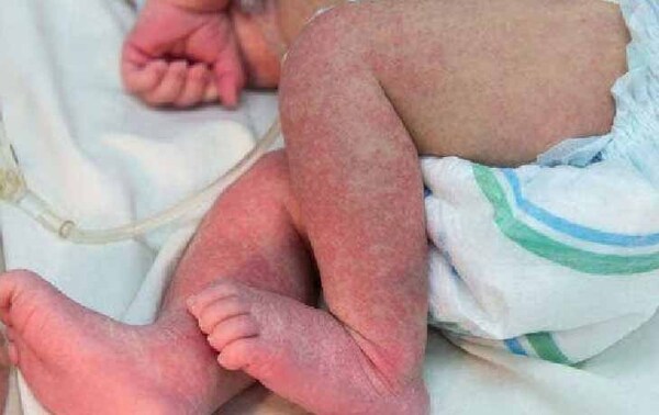 Hay 9 bebés internados en terapia intensiva por chikungunya en Hospital “Acosta Ñu” – Prensa 5
