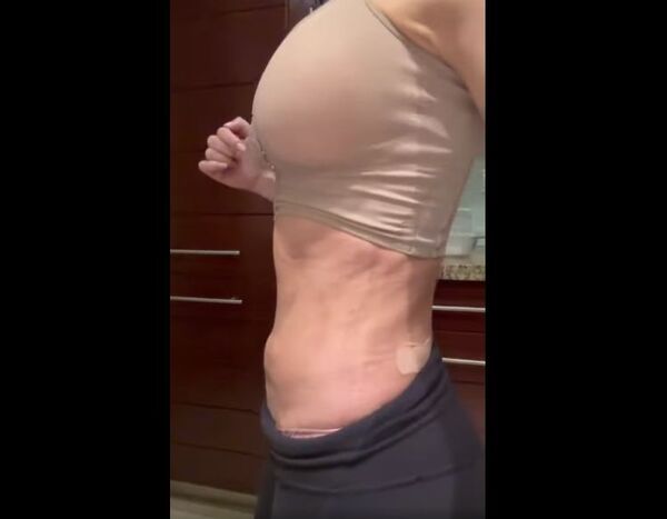 Diario HOY | VIDEO| El sueño del cuerpo perfecto convertido en terror: denuncian a cirujano