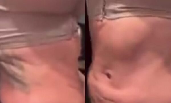 (VIDEO)Paraguaya fue víctima de mala praxis tras una lipo en Foz
