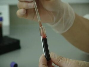 Leucemia Mieloide Aguda: 200 casos nuevos por año en Paraguay - Nacionales - ABC Color