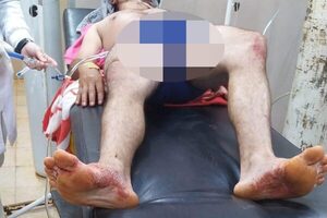 Escuchó ruido en el patio de su casa, salió a verificar y recibió un balazo – Diario TNPRESS