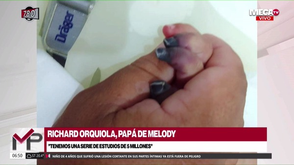 Amputaron deditos a bebita de 9 meses, pero hay posibilidades de implante - Megacadena — Últimas Noticias de Paraguay