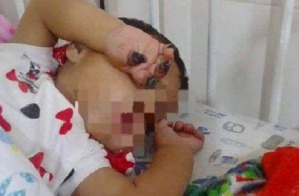Amputaron 4 dedos a la bebé que sufrió presunta negligencia médica - Noticiero Paraguay