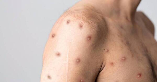 La Nación / Viruela del mono: OMS advierte que podrían producirse nuevos brotes