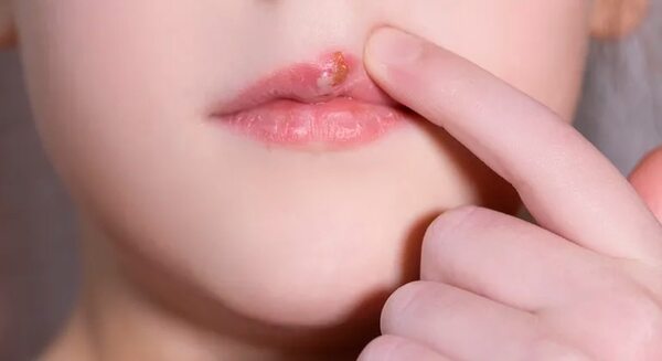 Herpes bucal en niños y niñas: qué es y cómo se contrae - Estilo de vida - ABC Color