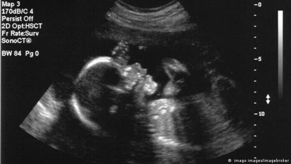 Médicos logran realizar con éxito la primera cirugía cerebral de un feto