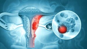 08 de mayo: Día Mundial del Cáncer de Ovario