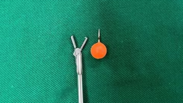 Niño tragó piercing que quedó clavado en su tráquea