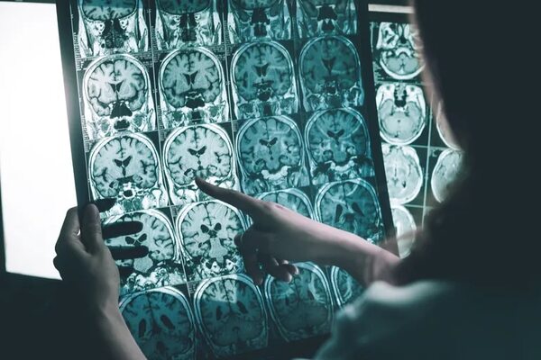 La detección por analítica de sangre y nuevos fármacos cambian el paradigma del alzhéimer - Ciencia - ABC Color