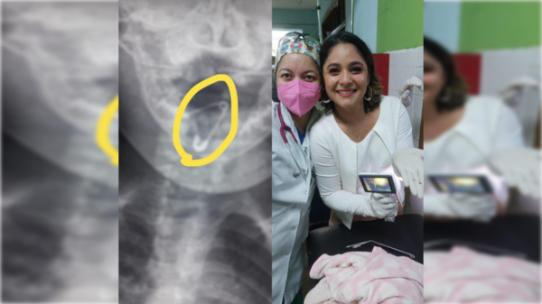 Doctoras salvan la vida a beba que tragó un alfiler