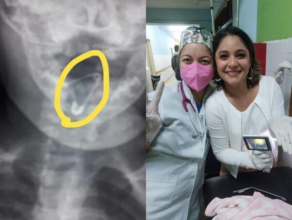 Coronel Oviedo: bebé tragó un prendedor y doctoras le salvan la vida - trece