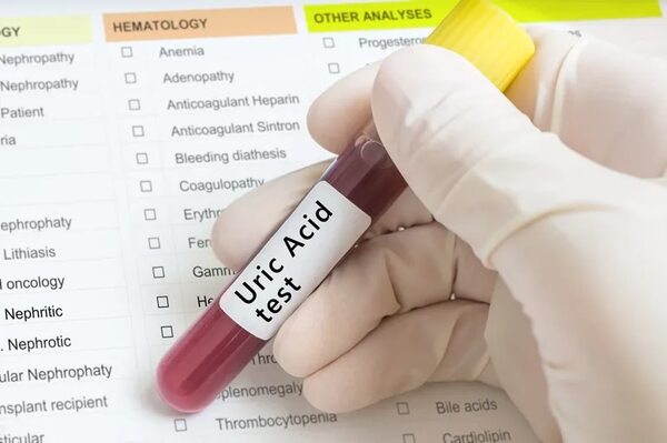 Cuidado con la hiperuricemia: tips para evitarla - Gastronomía - ABC Color