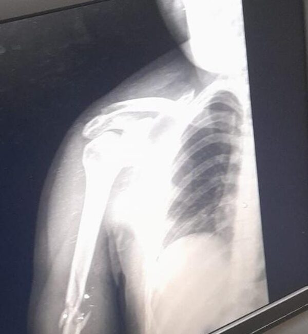 Asaltantes balean a joven al resistirse al robo de su motocicleta en Franco – Diario TNPRESS