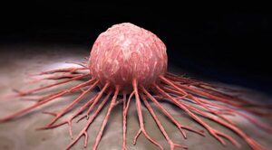 Un nuevo tratamiento reduce 74% avance de un raro cáncer de sangre