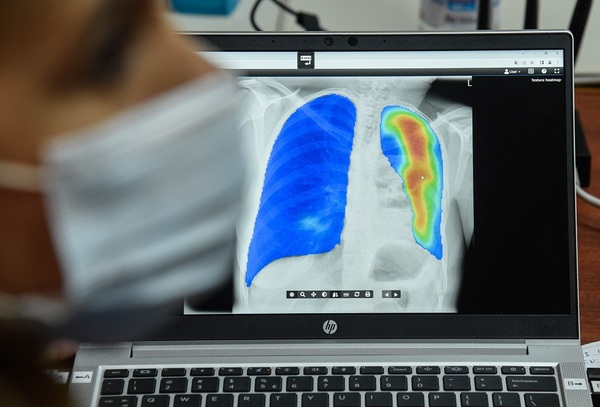Tuberculosis: Salud Pública recurre al uso de inteligencia artificial para detectar casos | 1000 Noticias