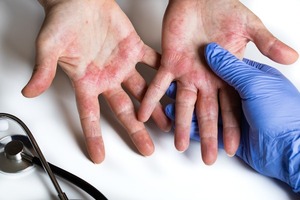 Dermatitis atópica en invierno: ¿Cómo tratarla? - Unicanal