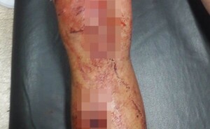 Violento ataque a machetazos a un hombre en Hernandarias
