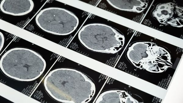 Cambio de estilo de vida puede prevenir la ELA (influyen factores genéticos, y ambientales)