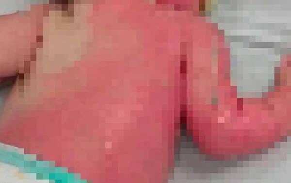 Mamá se tropezó y echó a su beba de 3 meses encima del brasero en Caaguazú – Prensa 5