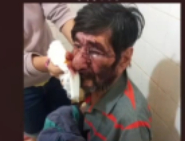 Septuagenario golpeado por su retoño “alhaja” perdió el ojo