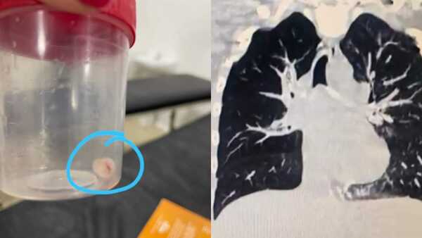 Encarnación: Extraen tapa de crema dental de las vías aéreas de un niño de 7 años