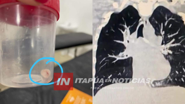 MÉDICOS DEL HRE SALVARON A UN NIÑO DE 7 AÑOS QUE SE ATRAGANTÓ CON UNA TAPITA DE PASTA DENTAL - Itapúa Noticias
