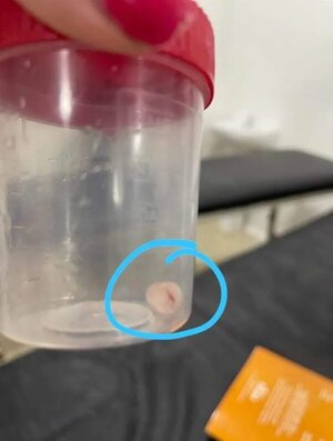 Extraen tapa de dentífrico de vía respiratoria de una niña de 7 años en el Hospital Regional de Encarnación - Nacionales - ABC Color