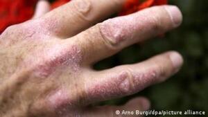 ¡Nos podemos dar la mano! La psoriasis no es contagiosa