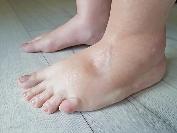 Cómo combatir los pies hinchados: Guía completa para aliviar la inflamación y saber qué la causa - Estilo de vida - ABC Color
