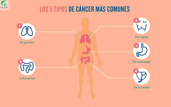 Día Mundial Contra el Cáncer: La Detección precoz clave para un tratamiento exitoso