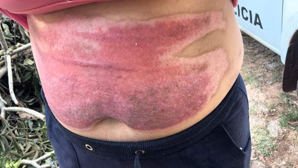 Cárcel para arriero infeliz que derramó combustible a su doña y le prendió fuego - La Clave