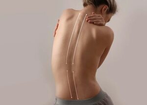 Ejercicios contra la escoliosis para hacer en casa - Estilo de vida - ABC Color
