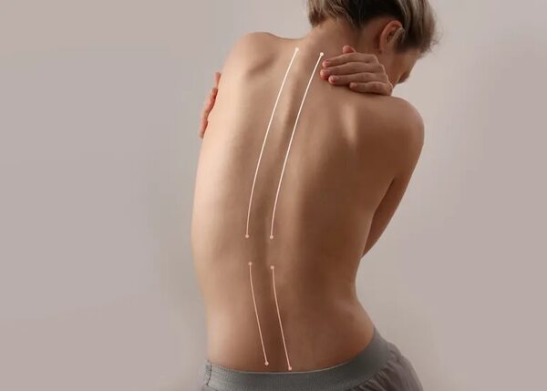 Ejercicios contra la escoliosis para hacer en casa - Estilo de vida - ABC Color