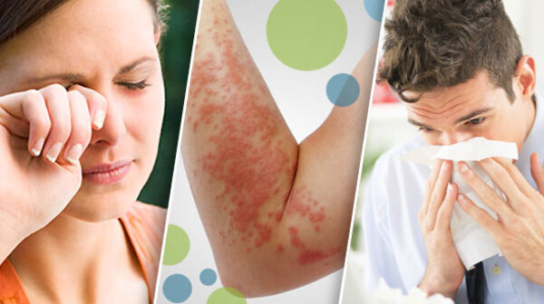 Día mundial de la Alergia: ¿Tienes algunas de éstas alergias? » San Lorenzo PY
