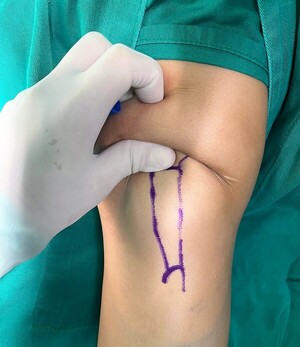 Médicos de la UNA realizan con éxito cirugías poco frecuentes en el marco de innovaciones en técnicas quirúrgicas – La Mira Digital