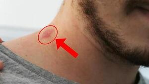 Novio miente a su pareja que encontró un chupón en su cuello "encima le creí"