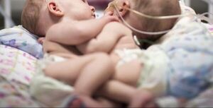 Reportan nacimiento de bebés siameses en Clínicas | 1000 Noticias