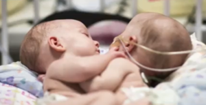 Nacieron bebés siameses en el Hospital de Clínicas: "Un capricho de la naturaleza" - C9N