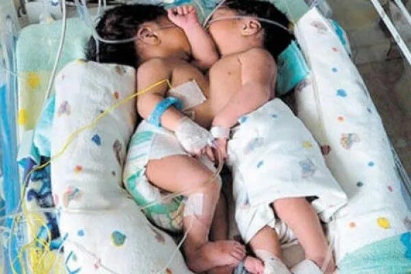 Bebés siameses son sometidos a cirugía en Hospital de Clínicas - Nacionales - ABC Color