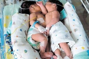 NACIERON SIAMESES EN EL HOSPITAL DE CLÍNICAS!!! - La Voz del Norte