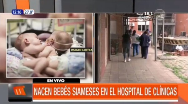 Nacen bebés siameses en el hospital de Clínicas | Telefuturo