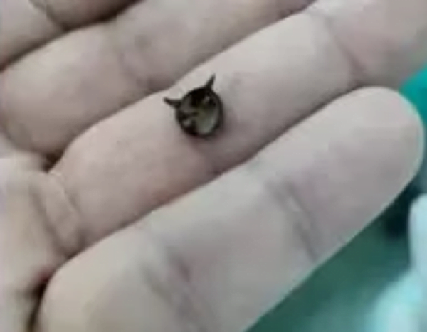 Extraen tacha de metal con puntas filosas del pulmón de un bebé - Noticiero Paraguay