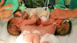Bebés siameses fueron operados de urgencia por complicaciones