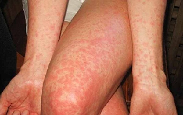Dengue y chikungunya con tendencia al descenso – Prensa 5
