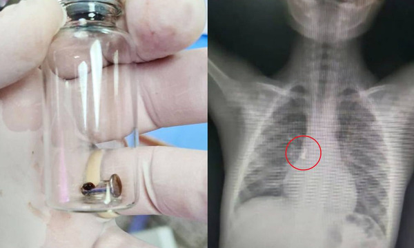 Preocupa a médicos casos de atragantamiento de niños tras muerte de bebé - OviedoPress