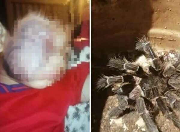Picadura de tarántula: Niño de 6 años necesita ayuda económica para adquirir más antídotos - ABC en el Este - ABC Color