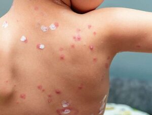 Fallece un niño de 11 años por complicaciones de la varicela · Radio Monumental 1080 AM