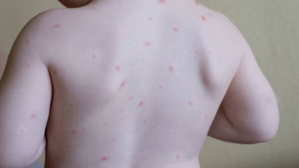 Médica alerta que sí puede haber “cuadros fulminantes” de varicela