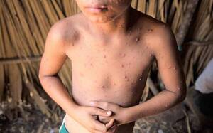 Niño de 11 años muere de varicela y papá contó: “Mi hijo me dijo que no se quería morir”