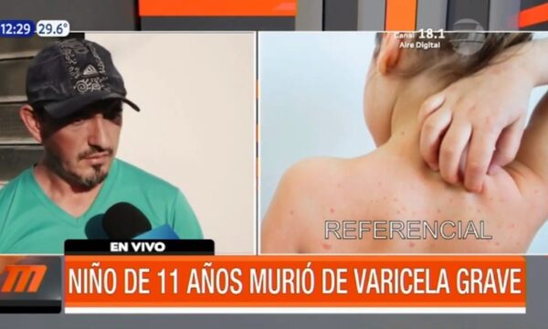 Niño de 11 años murió de varicela en Itauguá | Telefuturo
